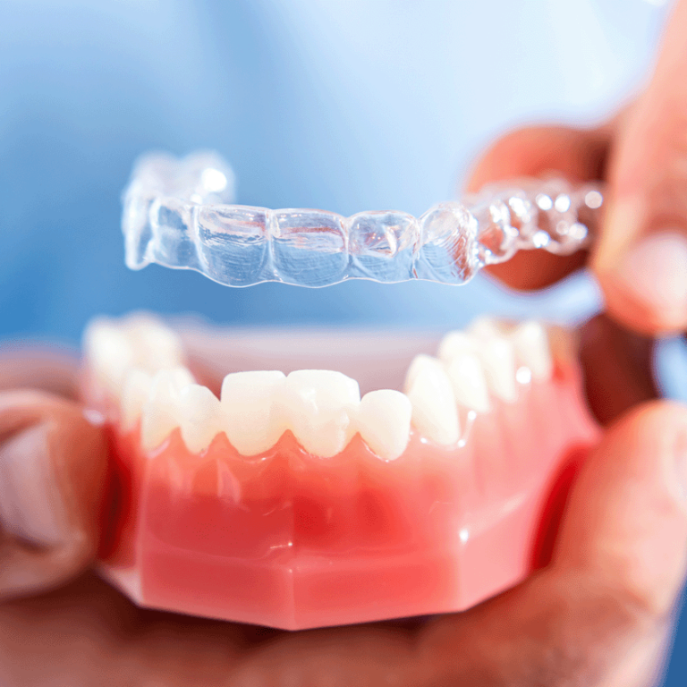 hand placing clear aligners on dental model