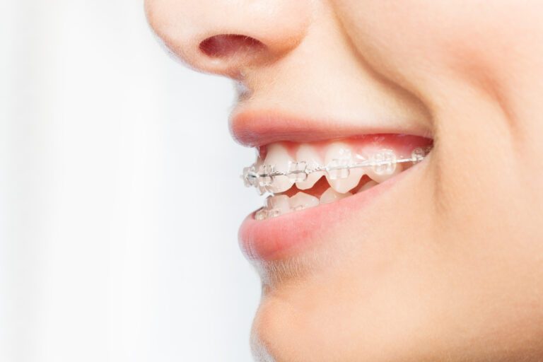 Profile close up of the smile of a woman with Damon Clear braces in Antioch, CA