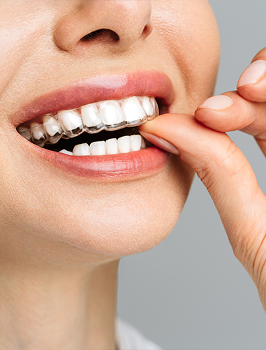 A White Woman With Clear Aligners